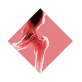 xray-overlay-hip overlay hip